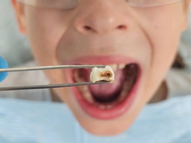 Best Emergency Dentist for Knocked-Out Tooth in Crane, MO